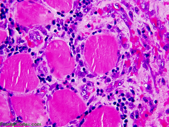 Dermatomyositis in lymphoma pati